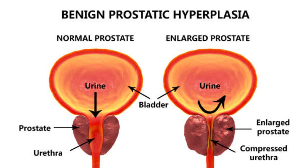 Top 10 Facts to Cure Enlarged Prostate – A Comprehensive Study on Benign Prostate Hyperplasia Or BPH