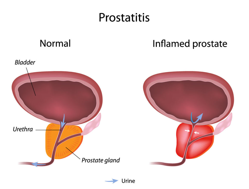 Top 10 Facts to Cure Enlarged Prostate – A Comprehensive Study on Benign Prostate Hyperplasia Or BPH