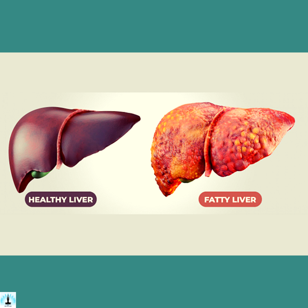 how do you convert a fatty liver to a normal liver